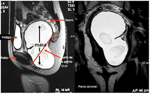 teratoma_sacrococcigeo_sacro/masa_pelvica_gluteo_izquierdo teratoma_sacrococcigeo_sacro/masa_pelvica_gluteo_izquierdo