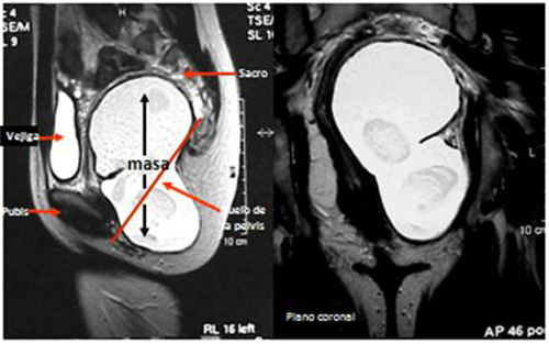 teratoma_sacrococcigeo_sacro/masa_pelvica_gluteo_izquierdo