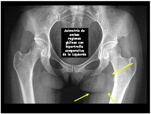 teratoma_sacrococcigeo_sacro/radiografia_ap_pelvis