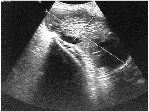 teratoma_sacrococcigeo_sacro/rnm_masa_pelvica teratoma_sacrococcigeo_sacro/rnm_masa_pelvica