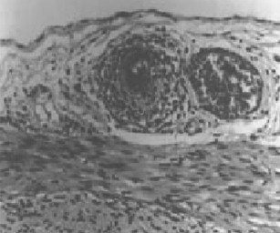 trombosis_mesenterica_lupus/vasculitis_necrosis_fibrinoide