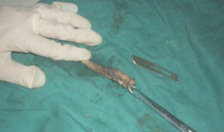 caso_apendicitis_apendicular/apendice_cecal_extirpado caso_apendicitis_apendicular/apendice_cecal_extirpado