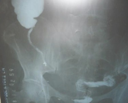 caso_apendicitis_apendicular/cuerpo_material_metalico caso_apendicitis_apendicular/cuerpo_material_metalico