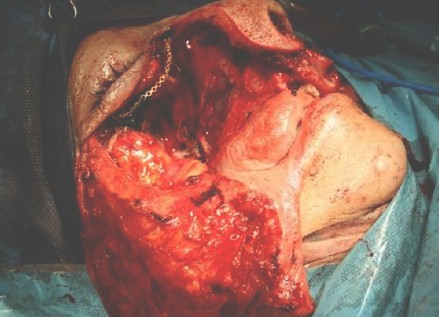 caso_clinico_ameloblastoma/tratamiento_quirurgico_cirugia
