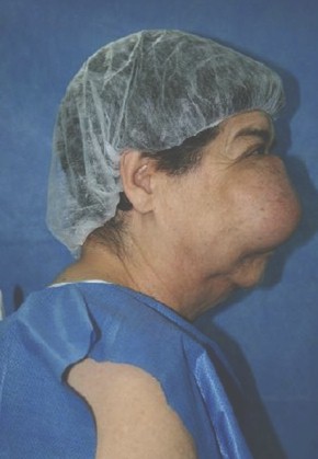 caso_clinico_ameloblastoma/tumor_diagnostico_tratamiento