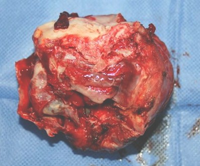 caso_clinico_ameloblastoma/tumor_extirpado_cirugia caso_clinico_ameloblastoma/tumor_extirpado_cirugia