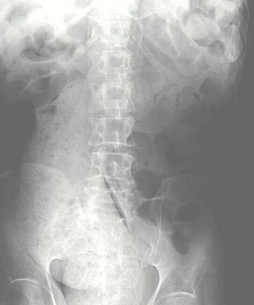 casos_fecalomas_gigantes/fecaloma_miga_pan