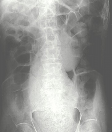 casos_fecalomas_gigantes/fecaloma_radiografia_litopedion