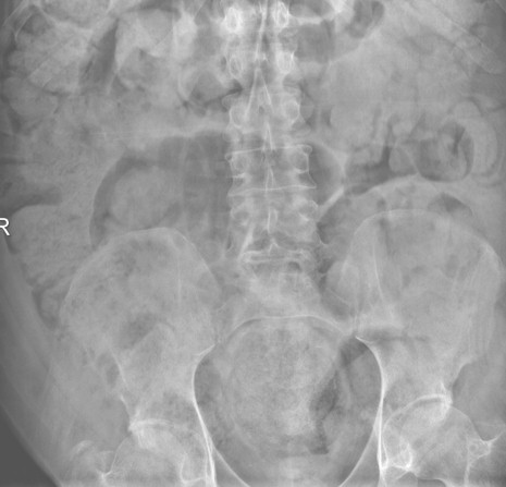 casos_fecalomas_gigantes/multiples_fecalomas_intestino