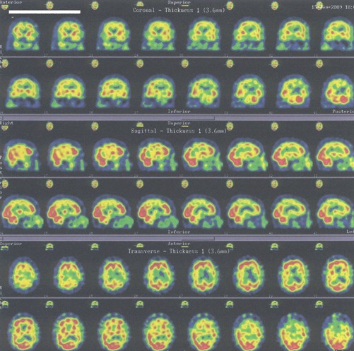 diagnostico_diferencial_demencia/imagen_imagenes_SPECT