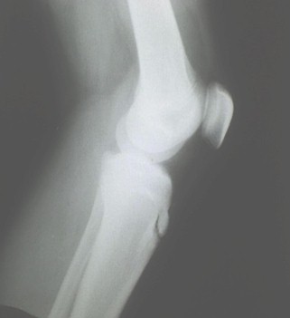 enfermedad_Osgood_Schlatter/radiografia_Rx_rodilla