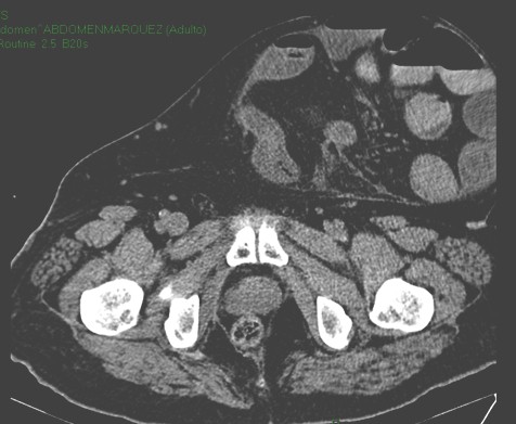 hernia_paraestomal_gigante/TAC_abdomen_eventracion hernia_paraestomal_gigante/TAC_abdomen_eventracion