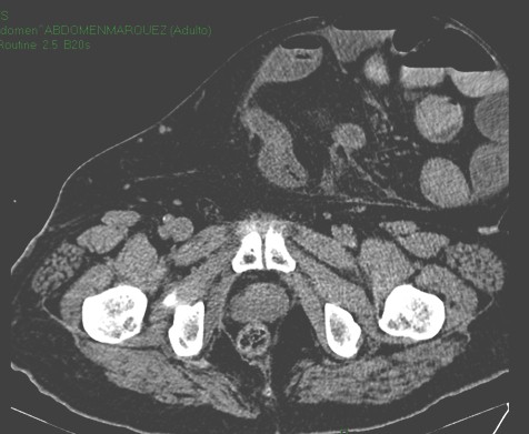 hernia_paraestomal_gigante/TAC_abdomen_eventracion