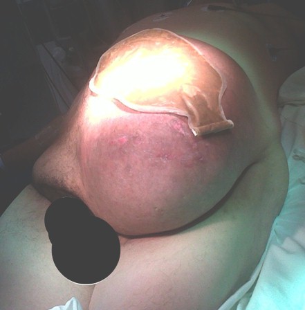 hernia_paraestomal_gigante/abdominal_estrangulada_ostomia