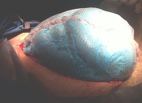 hernia_paraestomal_gigante/cirugia_eventracion_abdominal hernia_paraestomal_gigante/cirugia_eventracion_abdominal