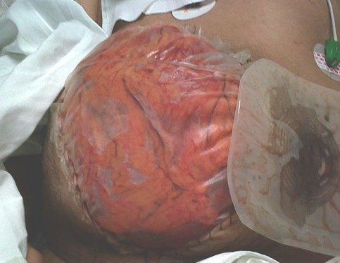 hernia_paraestomal_gigante/colostomia_funcional_eventracion hernia_paraestomal_gigante/colostomia_funcional_eventracion