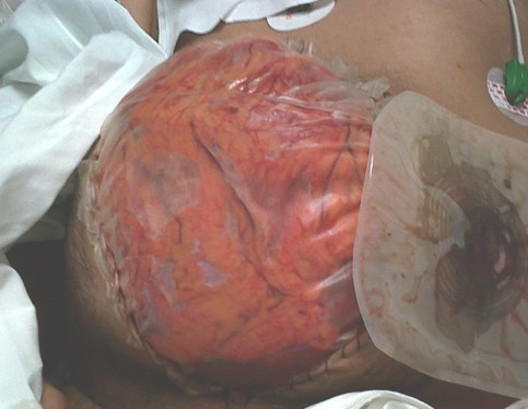 hernia_paraestomal_gigante/colostomia_funcional_eventracion