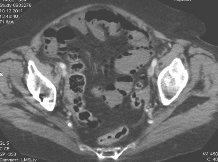 infarto_isquemia_mesenterica/aerobilia_neumatosis_intestinal