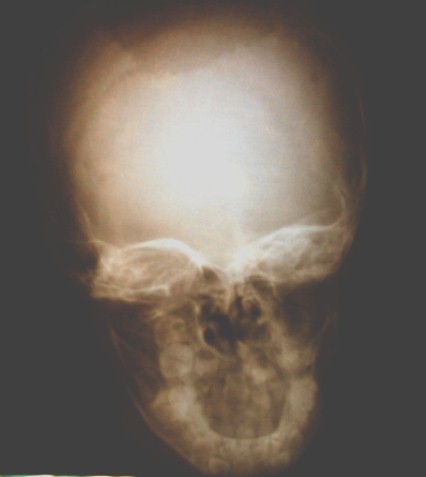 osteomielitis_boveda_craneal/RX_craneo_AP_frontal osteomielitis_boveda_craneal/RX_craneo_AP_frontal