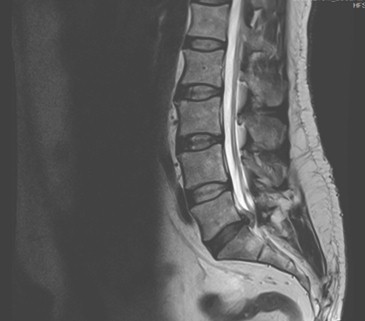 sindrome_cola_caballo/RMN_hernia_disco sindrome_cola_caballo/RMN_hernia_disco