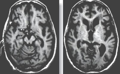 sindrome_enfermedad_Parkinson/RMN_resonancia_magnetica_nuclear