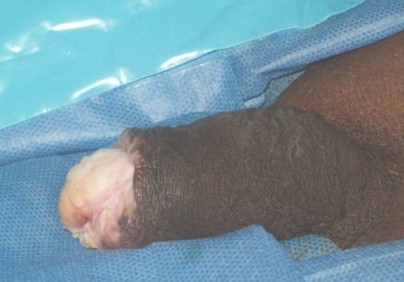 tumor_Buschke_Lowenstein/lesiones_verrucosas_pene tumor_Buschke_Lowenstein/lesiones_verrucosas_pene