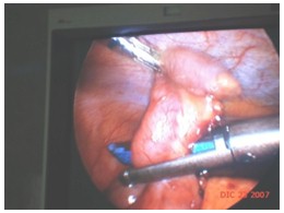 apendicectomia_laparoscopica_cirugia/extraccion_del_apendice2
