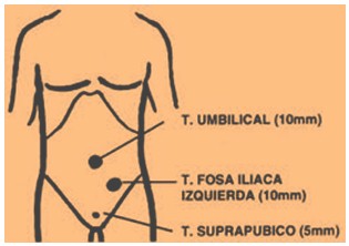 apendicectomia_laparoscopica_cirugia/lugares_de_incisiones