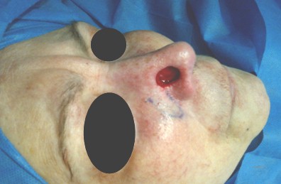 cancer_basocelular_nasal/cirugia_extirpacion_reseccion