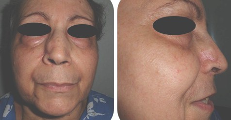 cancer_basocelular_nasal/evolucion_postoperatoria_meses cancer_basocelular_nasal/evolucion_postoperatoria_meses