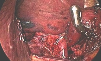 caso_esofagitis_peptica/funduplicatura_Nissen_laparoscopica caso_esofagitis_peptica/funduplicatura_Nissen_laparoscopica
