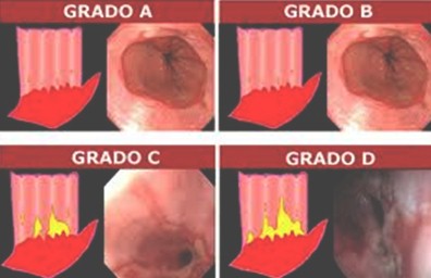 caso_esofagitis_peptica/reflujo_clasificacion_Angeles