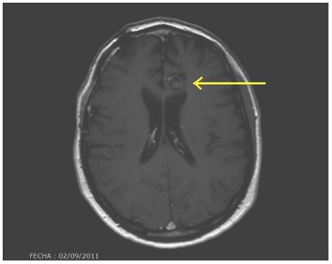 cavernoma_lobulo_frontal/lesion_supratentorial_intraaxial