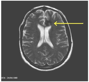 cavernoma_lobulo_frontal/lesion_supratentorial_izquierda