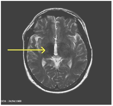 cavernoma_lobulo_frontal/resultado_intervencion_derecha