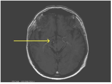 cavernoma_lobulo_frontal/resultado_tras_intervencion