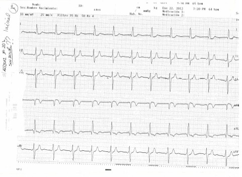 enfermedad_coronaria_ECG/ECG_1_ingreso_1