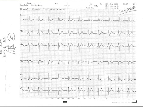 enfermedad_coronaria_ECG/ECG_sin_dolor