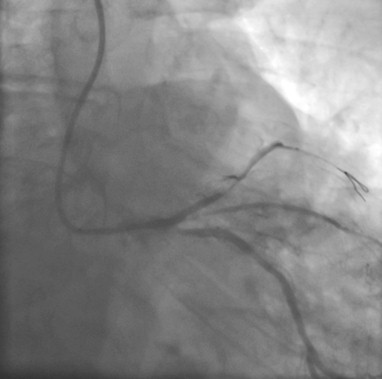 enfermedad_coronaria_ECG/oclusion_descendente_anterior