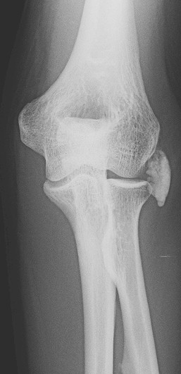 epicondilitis_diagnostico_tratamiento/radiografia_Rx_calcificacion