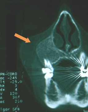 hiperparatiroidismo_tumor_pardo/TAC_maxilar_superior