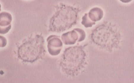 leucemia_celulas_peludas/anatomia_patologica_citoplasma