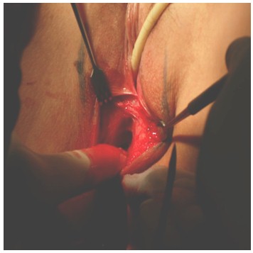 neovagina_agenesia_vaginal/creacion_espacio_vaginal neovagina_agenesia_vaginal/creacion_espacio_vaginal