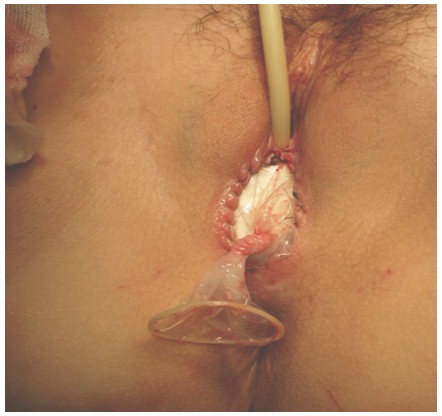 neovagina_agenesia_vaginal/imagen_de_neovagina neovagina_agenesia_vaginal/imagen_de_neovagina