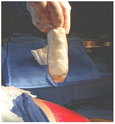 neovagina_agenesia_vaginal/protesis_artesanal_injerto neovagina_agenesia_vaginal/protesis_artesanal_injerto