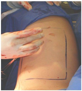 neovagina_agenesia_vaginal/sitio_donador_injerto neovagina_agenesia_vaginal/sitio_donador_injerto