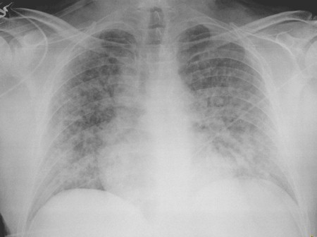 neumonia_infeccion_varicela/Rx_infiltrado_reticulonodular