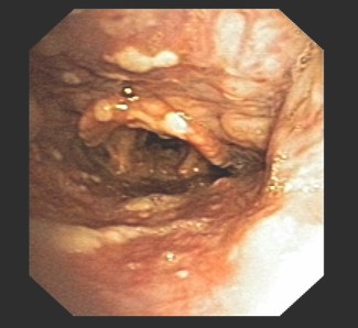 neumonia_infeccion_varicela/fibrobroncoscopia_vesiculas_pustulosas