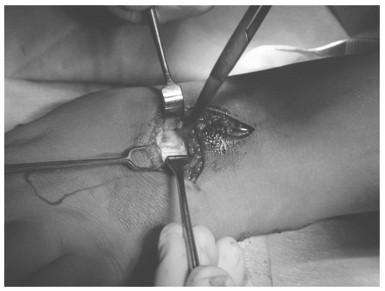 lisis_cerebral_infantil/ecrb_compartimiento_mano lisis_cerebral_infantil/ecrb_compartimiento_mano