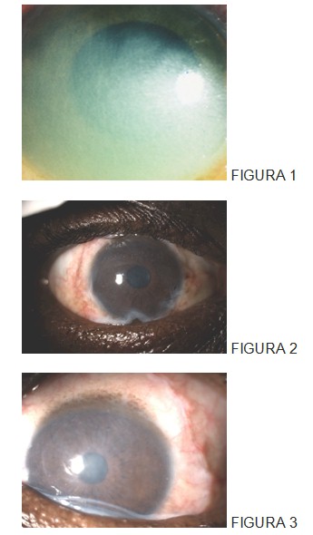 trasplante_membrana_amniotica/quemadura_ojo_oftalmologia